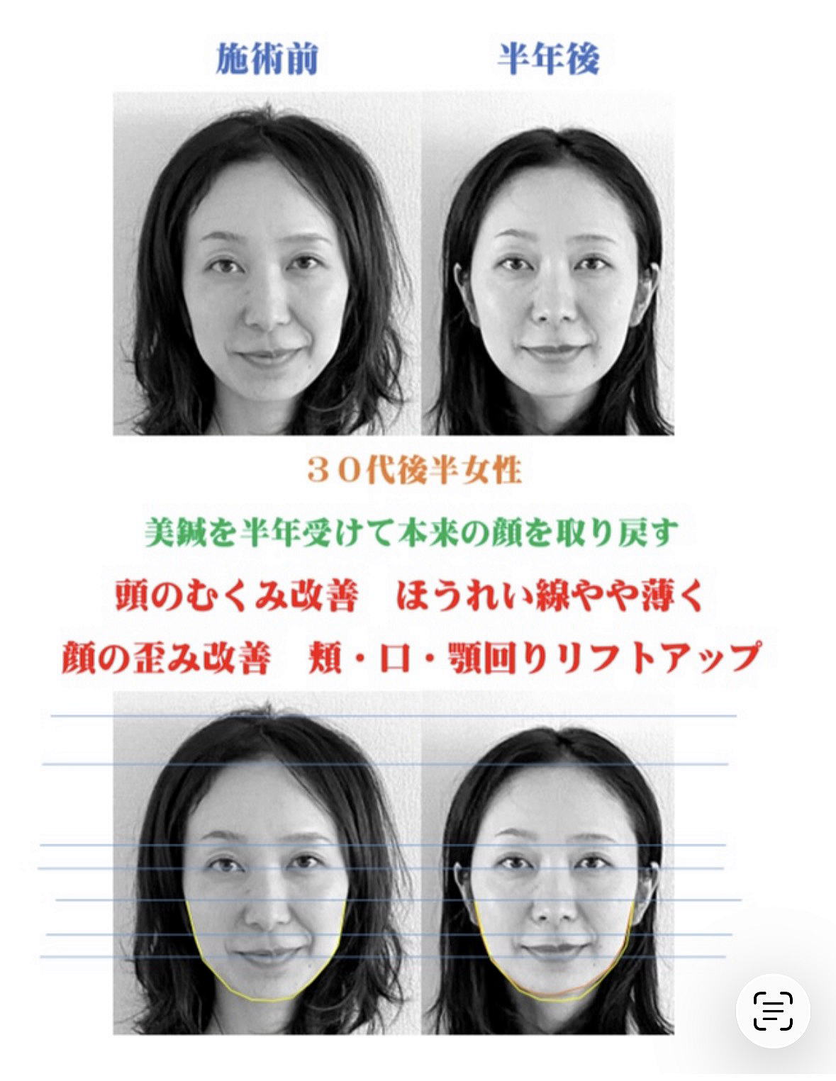 名古屋の美容鍼によるほうれい線と顎ラインのリフトアップ症例