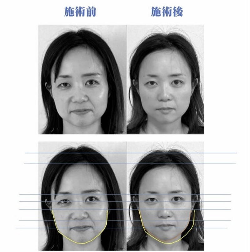 名古屋の美容鍼によるほうれい線改善症例４０代女性