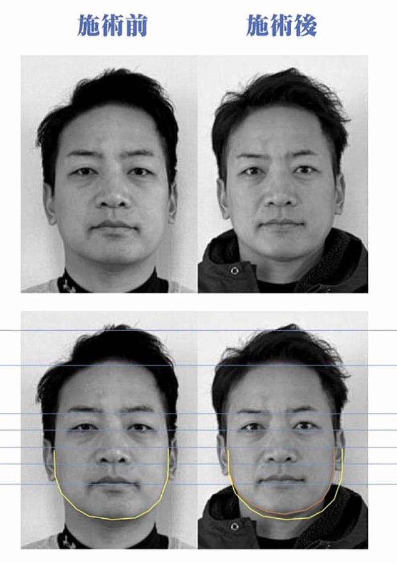 名古屋の美容鍼|30代たるみ改善症例 名古屋で美容鍼を受けた30代の口周りたるみ改善症例