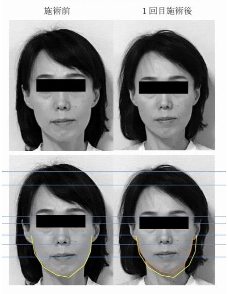 名古屋の美容鍼|50代女性たるみ改善症例 名古屋の美容鍼による50代女性のたるみ改善ビフォーアフター写真