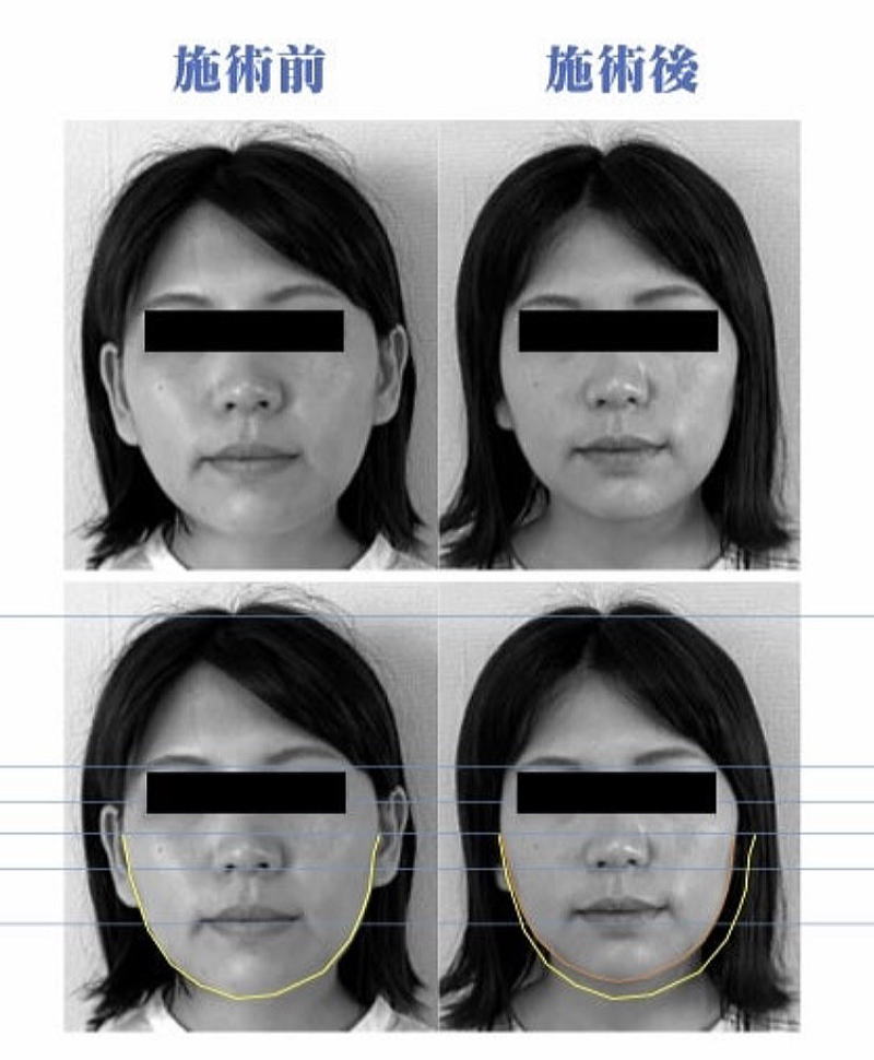 名古屋で顔のむくみが改善|美容鍼施術前後の比較症例|休息治療院 名古屋の休息治療院で美容鍼を受けた女性のむくみ改善例。施術前後で頬とフェイスラインが引き締まった比較写真