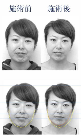 名古屋市東区の美容鍼によるリフトアップとほうれい線改善の施術前後症例写真