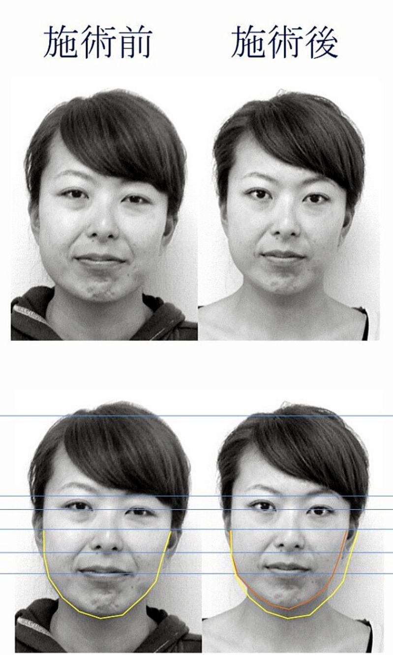 名古屋の美容鍼による顔のむくみ改善症例|施術前後比較|休息治療院 名古屋の休息治療院で美容鍼を受けた30代女性の顔のむくみ改善症例。施術前後でフェイスラインがすっきりした比較写真