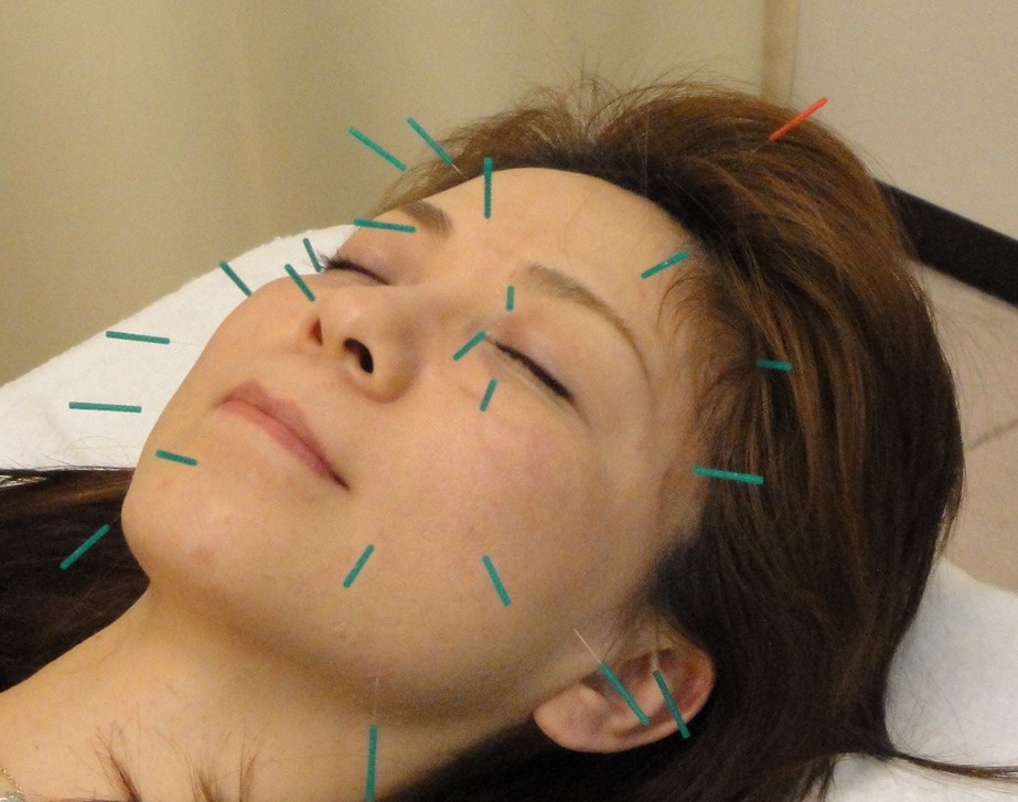 名古屋で美容鍼を受ける女性|休息治療院の美容鍼施術風景